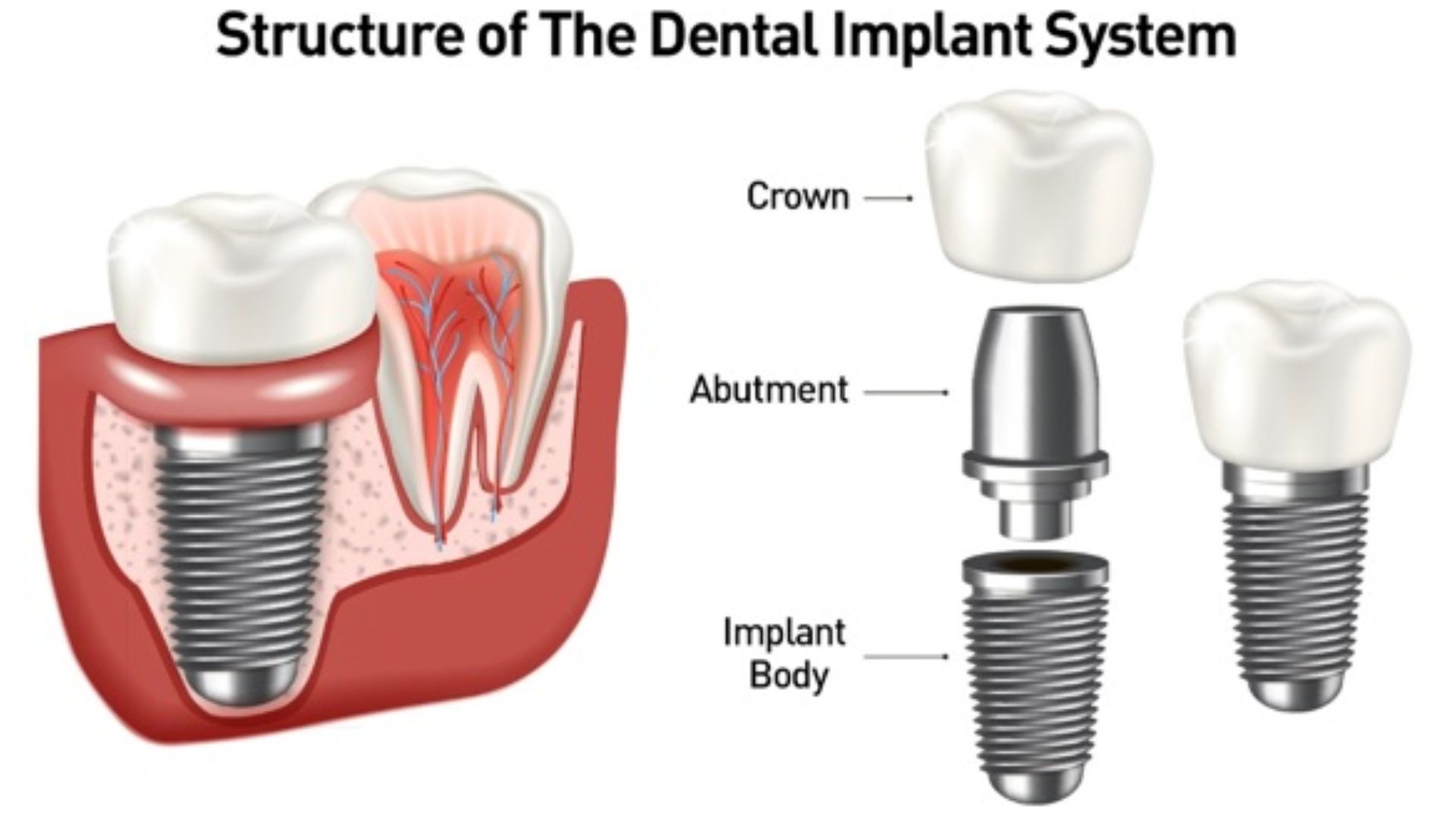 Legitimate Resources for Dental Implant Assistance